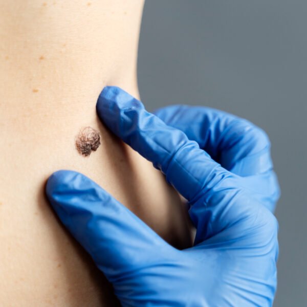 Como eliminar furúnculo em uma noite? Métodos seguros e eficazes