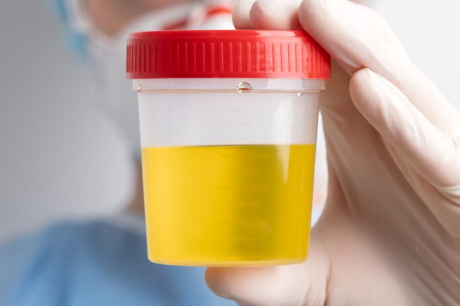 Filamento de muco na urina: causas, diagnóstico e cuidados